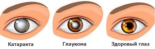 как определить катаракту и глаукому