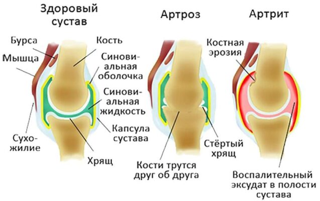 Доктор евдокименко лечение артрита