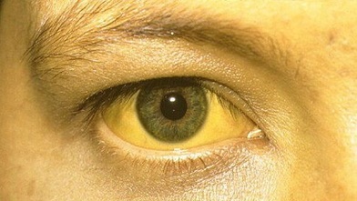 Цвет глаз при циррозе печени