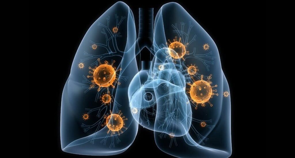 как определят пневмонию